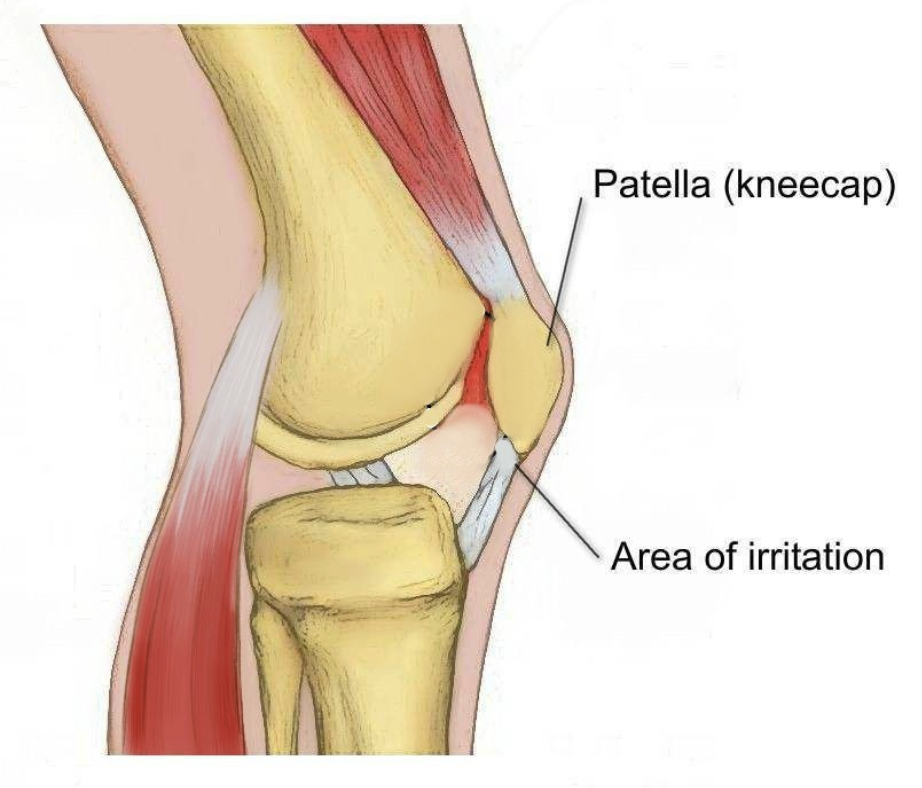 kneecap injury